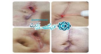 تاثیر پلاسما درمانی بر بهبود بازشدگی های محل عمل جراحی