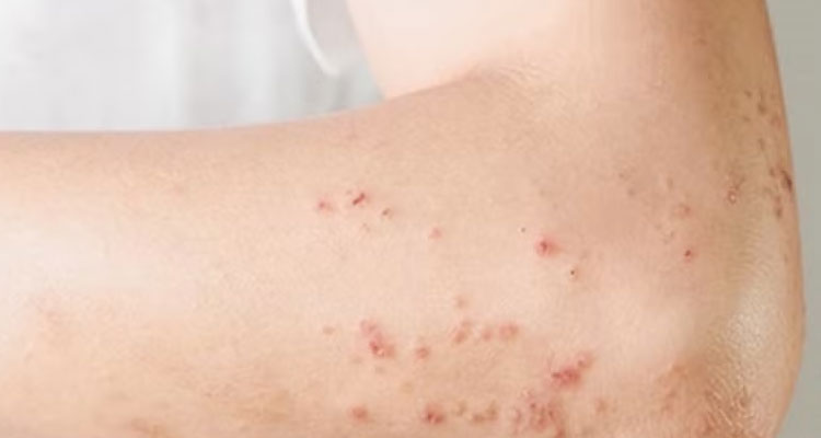 بیماری لیکن پلان