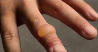 تاول چیست و چه انواعی دارد؟ چگونه در خانه آن را درمان کنیم؟