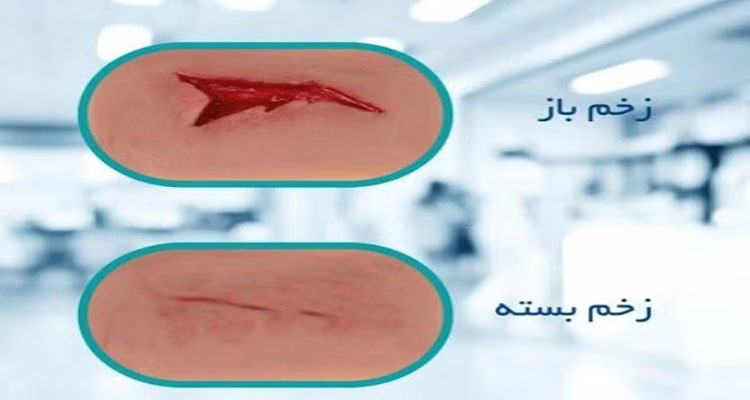 زخم باز