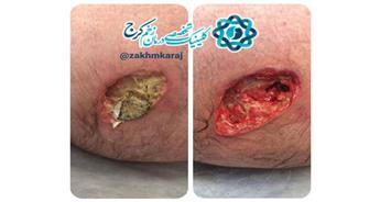 خطر بروز آبسه در اثر عدم رعایت اصول آسپتیک در تزریقات عضلانی