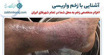 زخم های واریسی چیست؟ عوارض + روش های درمان آن