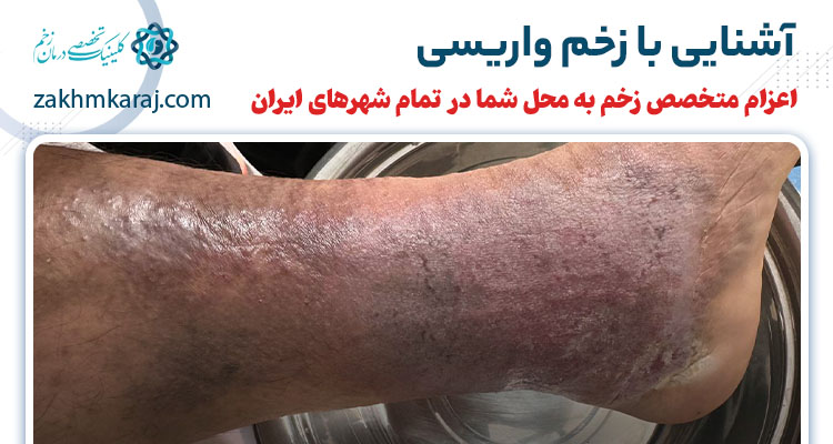 زخم های واریسی چیست؟