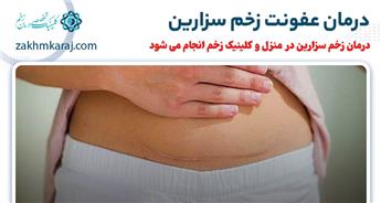 درمان عفونت بخیه سزارین در منزل و کلینیک