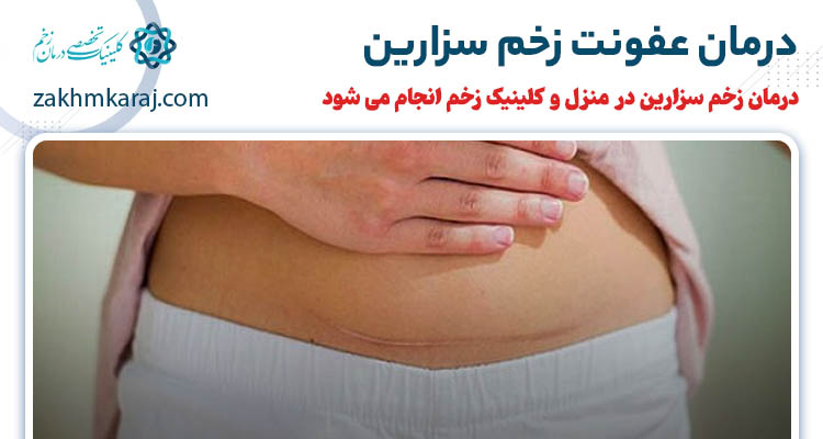 درمان عفونت بخیه سزارین در منزل