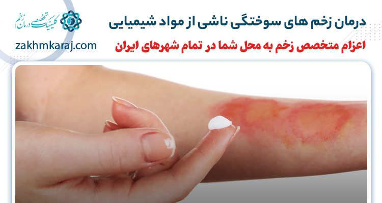 درمان زخم های سوختگی ناشی از مواد شیمیایی
