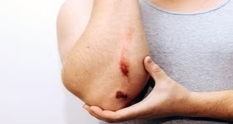 تسریع بهبود زخم