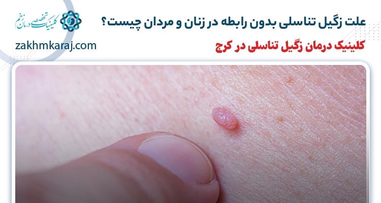 علت زگیل تناسلی بدون رابطه در زنان و مردان چیست؟