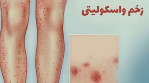 زخم‌ واسکولیتی