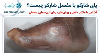 پای شارکو یا مفصل شارکو چیست؟ علائم، دلایل و روش‌های درمان