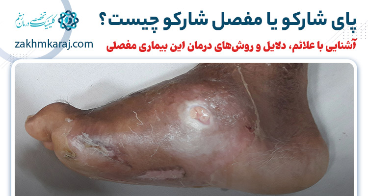 پای شارکو یا مفصل شارکو چیست؟