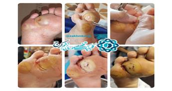 اهمیت خودکنترلی در پیشگیری از زخم پای دیابتی