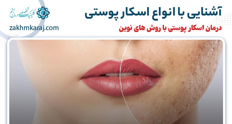 اسکار پوستی چیست و چه انواعی دارد؟