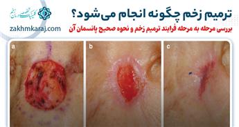 ترمیم زخم چگونه انجام می‌شود؟ بررسی مراحل بازسازی پوست