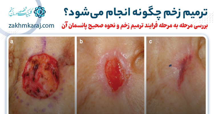 فرایند ترمیم زخم