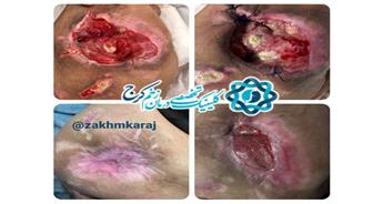 تاثیر وکیوم تراپی بر بهبود زخم‌ها در فاز پرولیفراتیو