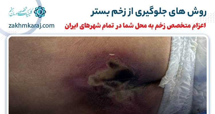 چگونه از به وجود آمدن زخم بستر جلوگیری کنیم؟