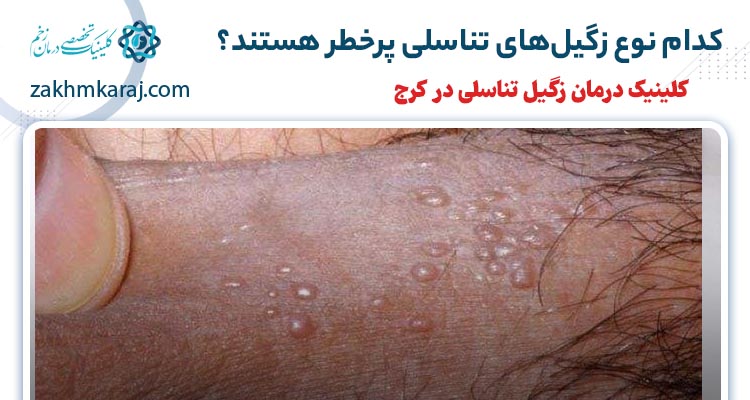 کدام نوع زگیل تناسلی خطرناک است؟