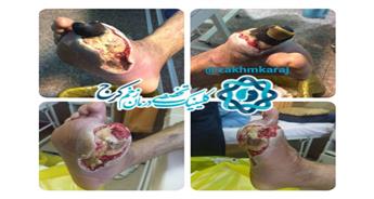 اهمیت درک زبان زخم و تاثیر آن بر اثربخشی روش‌هایی درمانی