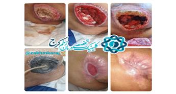 وکیوم تراپی و نقش آن در تسریع بهبود زخم‌های فشاری