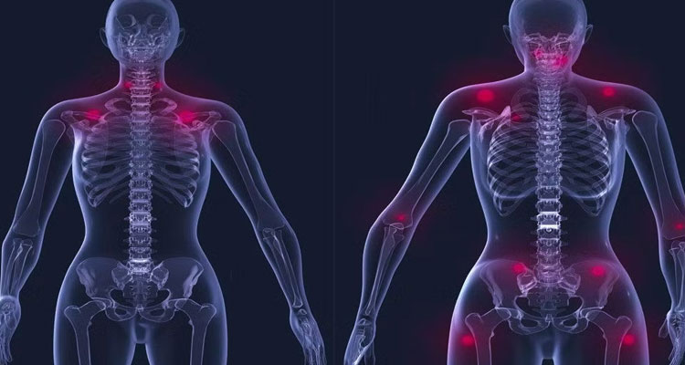 فیبرومیالژیا