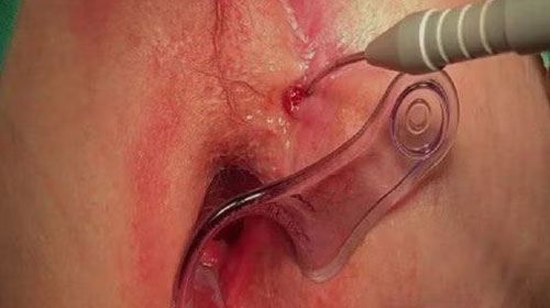 فیستول مقعدی