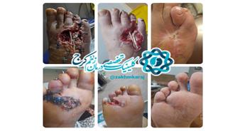 درمان تیمی چند تخصصی حفظ پای مجروح ناشی از شلیک گلوله