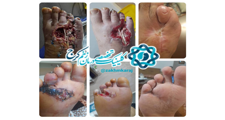 درمان تیمی چند تخصصی حفظ پای مجروح ناشی از شلیک گلوله