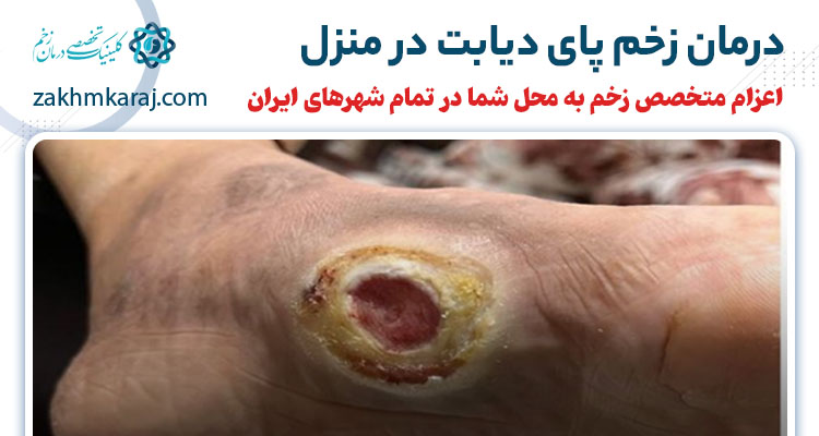 درمان زخم دیابتی در منزل
