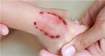 چگونه جای گازگرفتگی سگ یا گربه را درمان کنیم؟