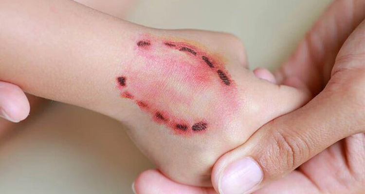 درمان گاز گرفتگی حیوانات