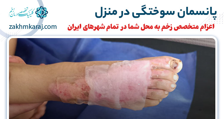 پانسمان سوختگی در منزل