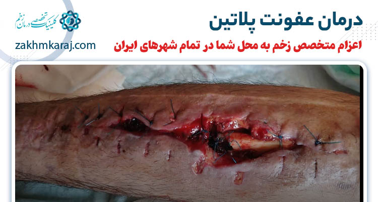 عفونت پلاتین و روش های درمان آن