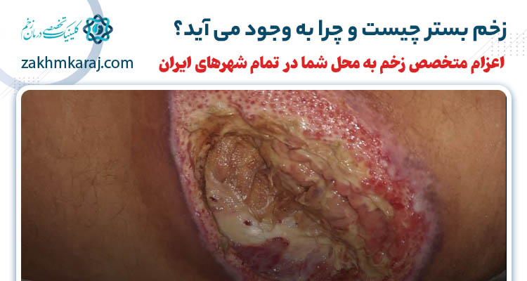 زخم بستر چیست و چگونه به وجود می‌آید؟
