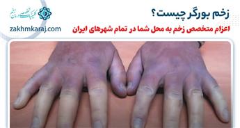 زخم بورگر چیست؟