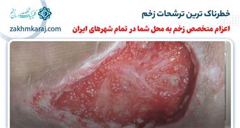 خطرناک ترین ترشحات زخم کدامند؟ ترشحات زخم (اگزودا)