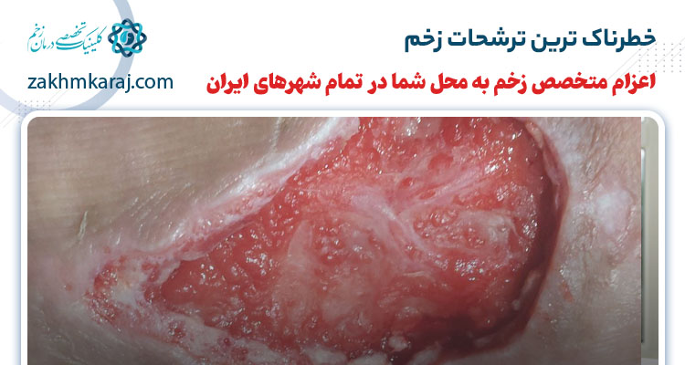 خطرناک ترین ترشحات زخم