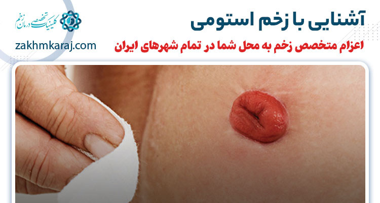 زخم استومی چیست؟