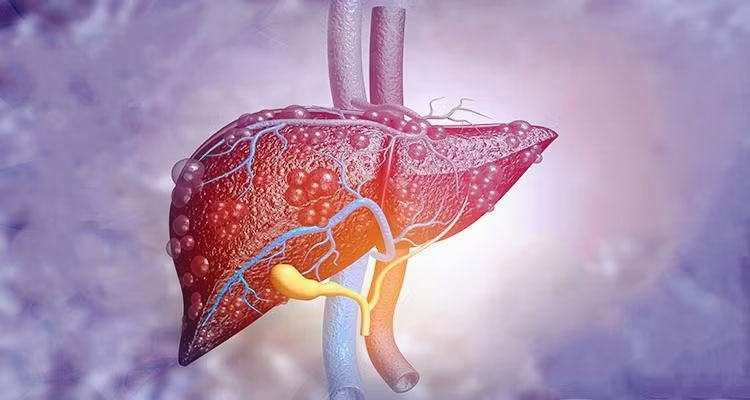 کبد چرب و دیابت