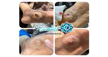 روان‌زخم و تاثیر بر تبعیت بیمار از تشخیص پزشکی، در یک ‌مورد زخم‌ پای دیابتی