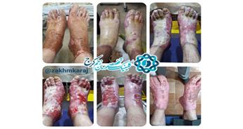 درمان کمردرد با ماده رادیواکتیو و ریسک قطع هر دو اندام تحتانی