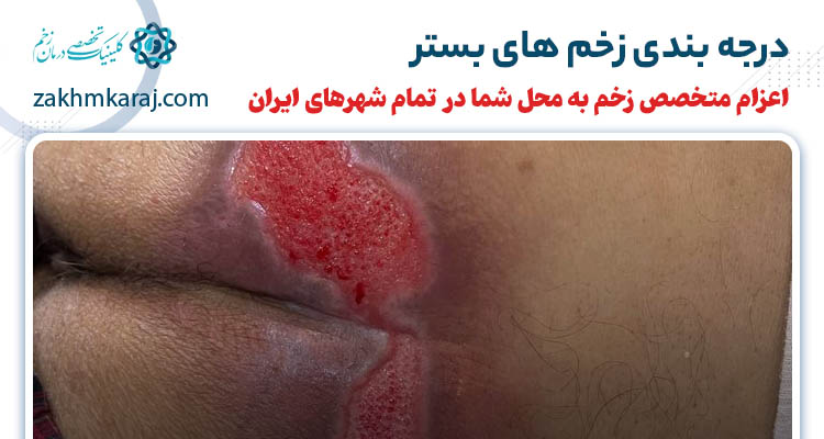 آشنایی با انواع گریدهای زخم بستر