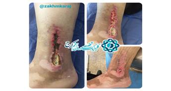 مدیریت تیمی دهیسنس‌های محل اعمال‌جراحی ارتوپدی