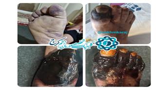 قطع عضو کامل به دنبال مراجعه به افراد فاقد صلاحیت علمی