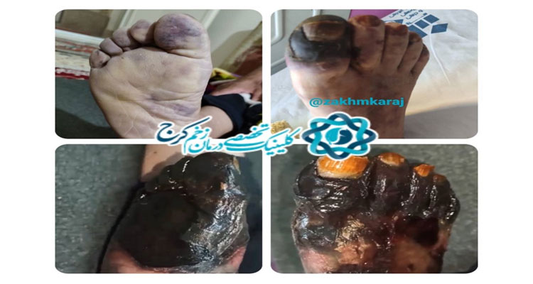 قطع عضو کامل به دنبال مراجعه به افراد فاقد صلاحیت علمی