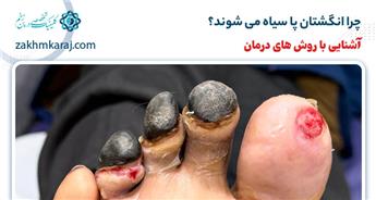 چرا انگشتان پا سیاه می شوند؟ (8 دلیل مهم)