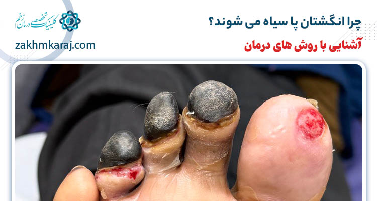 چرا انگشتان پا سیاه می شوند؟