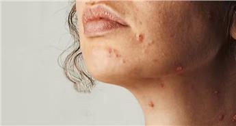 چگونه جای آبله مرغان را درمان کنیم؟