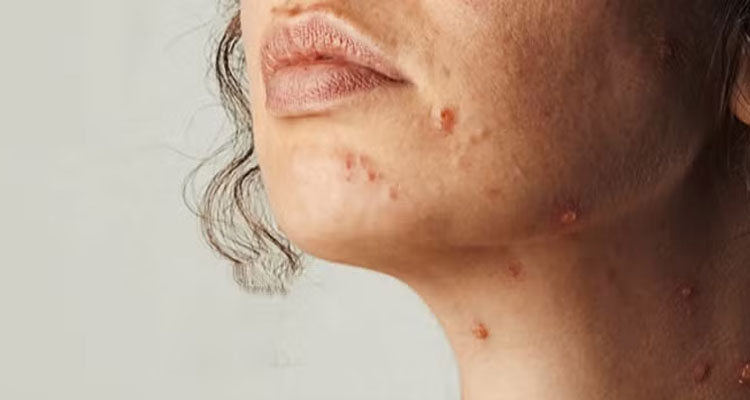 درمان اسکار آبله مرغان