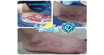 بررسی عوامل تاخیر در درمان در یک مورد زخم حاد ناشی از تروما